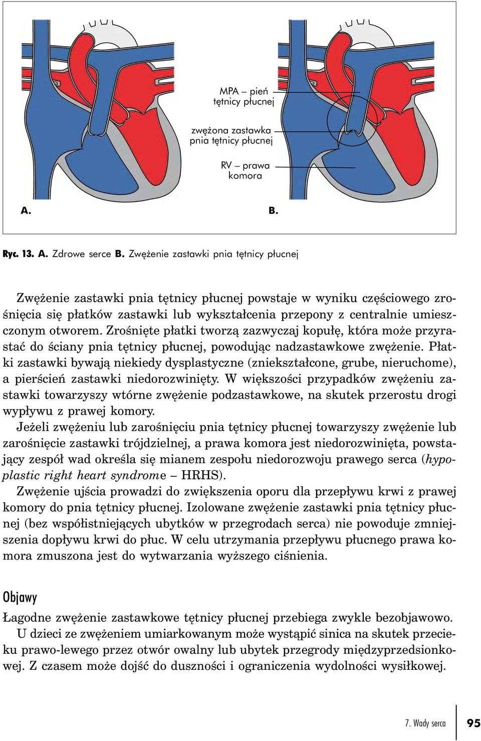 otworem. Zrośnięte płatki tworzą zazwyczaj kopułę, która może przyrastać do ściany pnia tętnicy płucnej, powodując nadzastawkowe zwężenie.