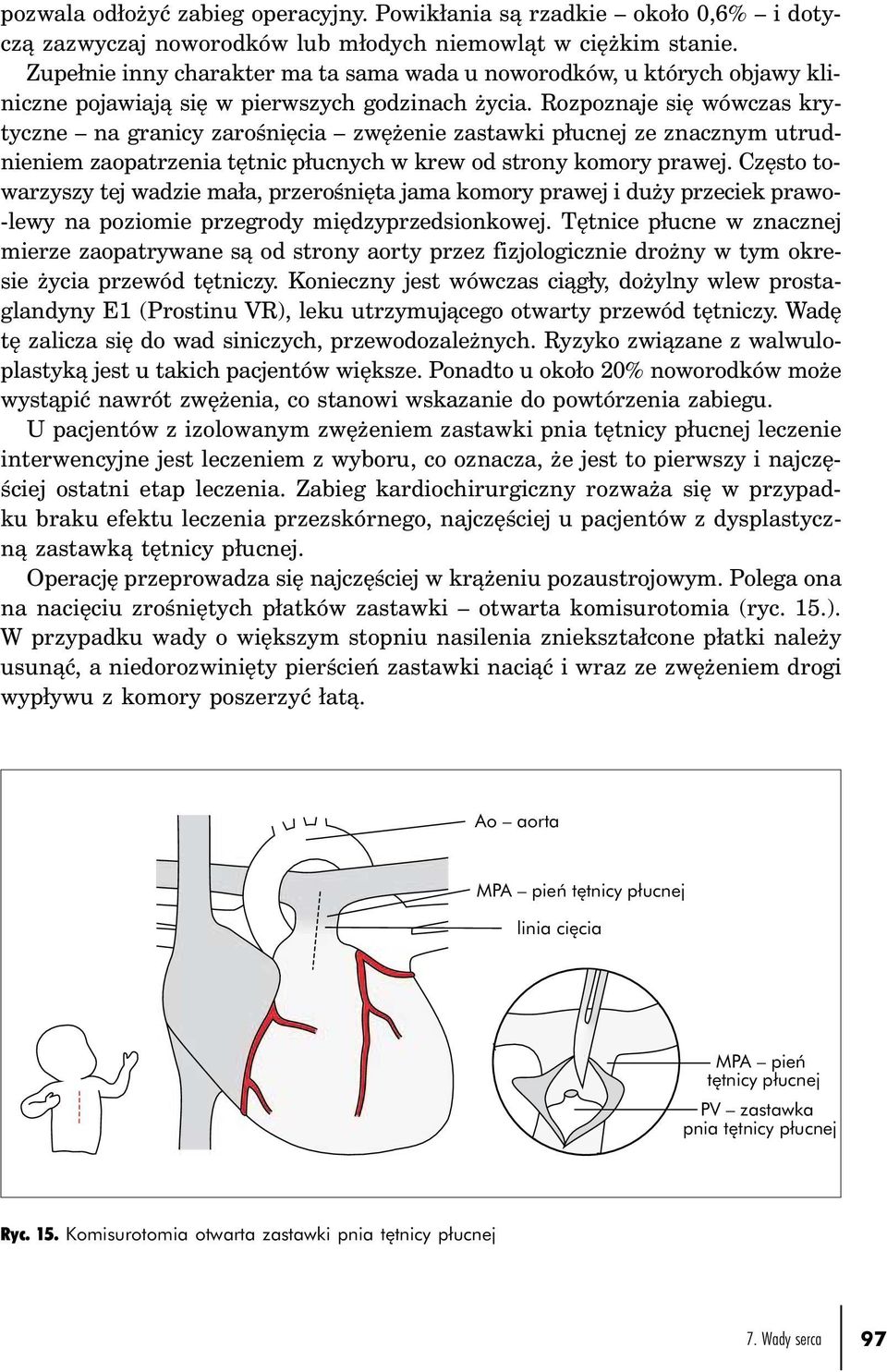 Rozpoznaje się wówczas krytyczne na granicy zarośnięcia zwężenie zastawki płucnej ze znacznym utrudnieniem zaopatrzenia tętnic płucnych w krew od strony komory prawej.