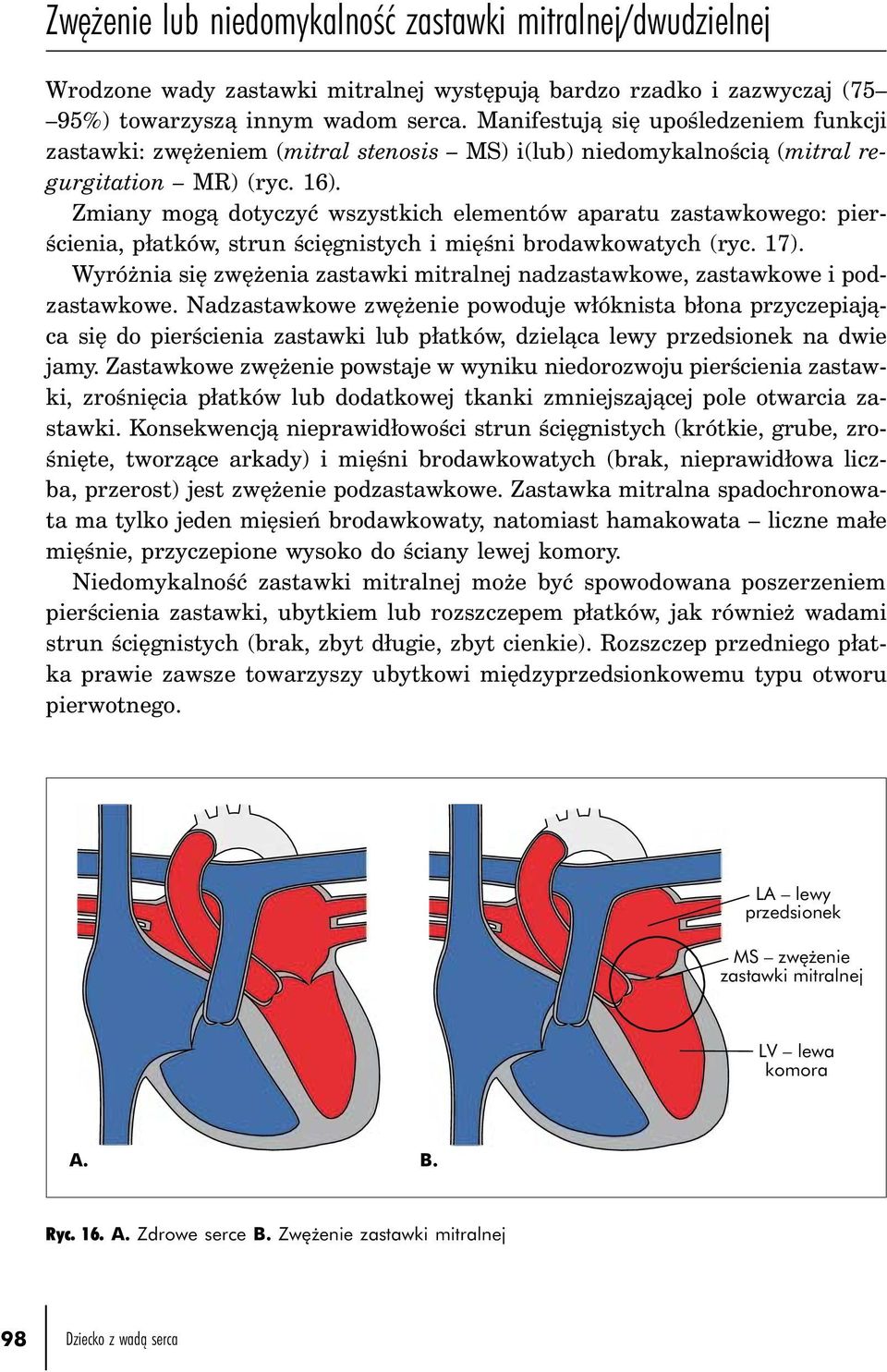 Zmiany mogą dotyczyć wszystkich elementów aparatu zastawkowego: pierścienia, płatków, strun ścięgnistych i mięśni brodawkowatych (ryc. 17).