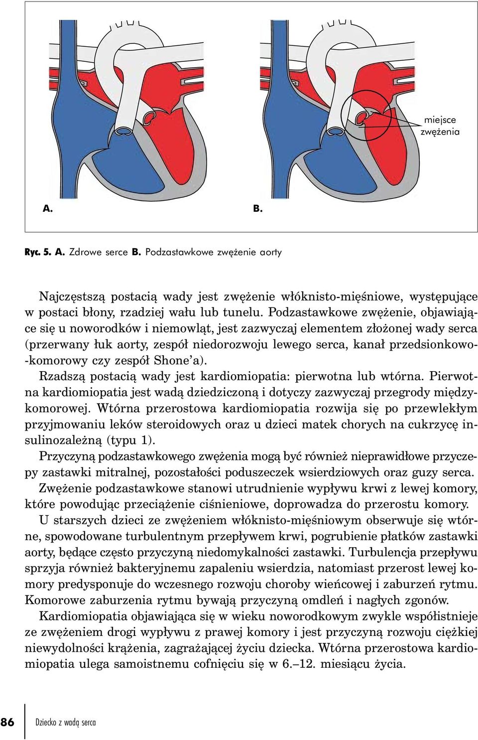 czy zespół Shone a). Rzadszą postacią wady jest kardiomiopatia: pierwotna lub wtórna. Pierwotna kardiomiopatia jest wadą dziedziczoną i dotyczy zazwyczaj przegrody międzykomorowej.