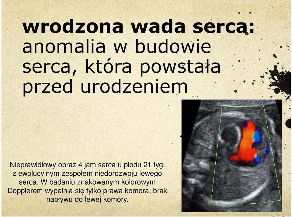 z ewolucyjnym zespołem niedorozwoju lewego serca.