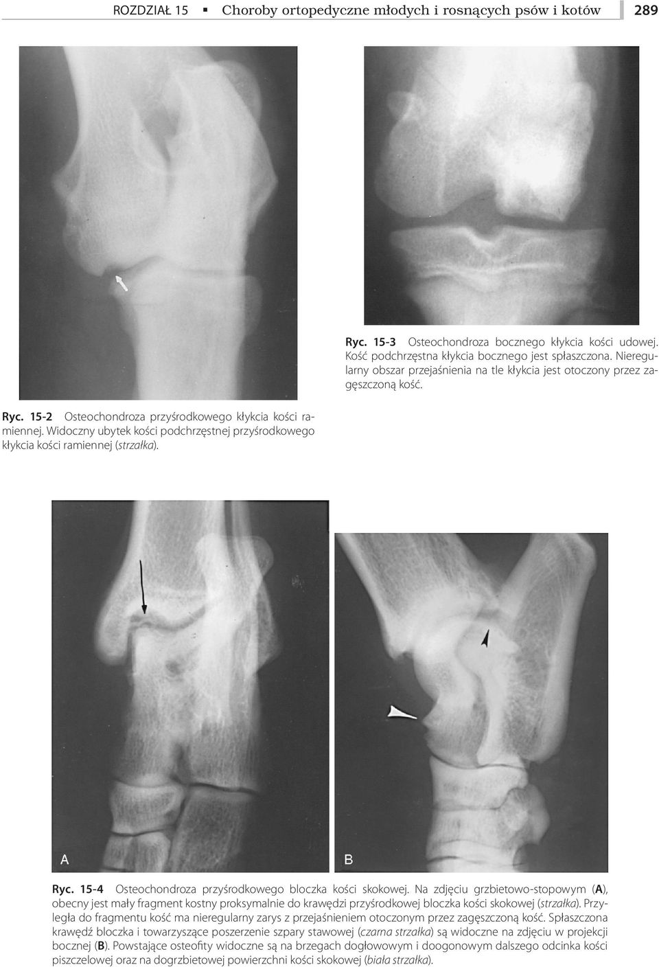 Widoczny ubytek kości podchrzęstnej przyśrodkowego kłykcia kości ramiennej (strzałka). Ryc. 15-4 Osteochondroza przyśrodkowego bloczka kości skokowej.