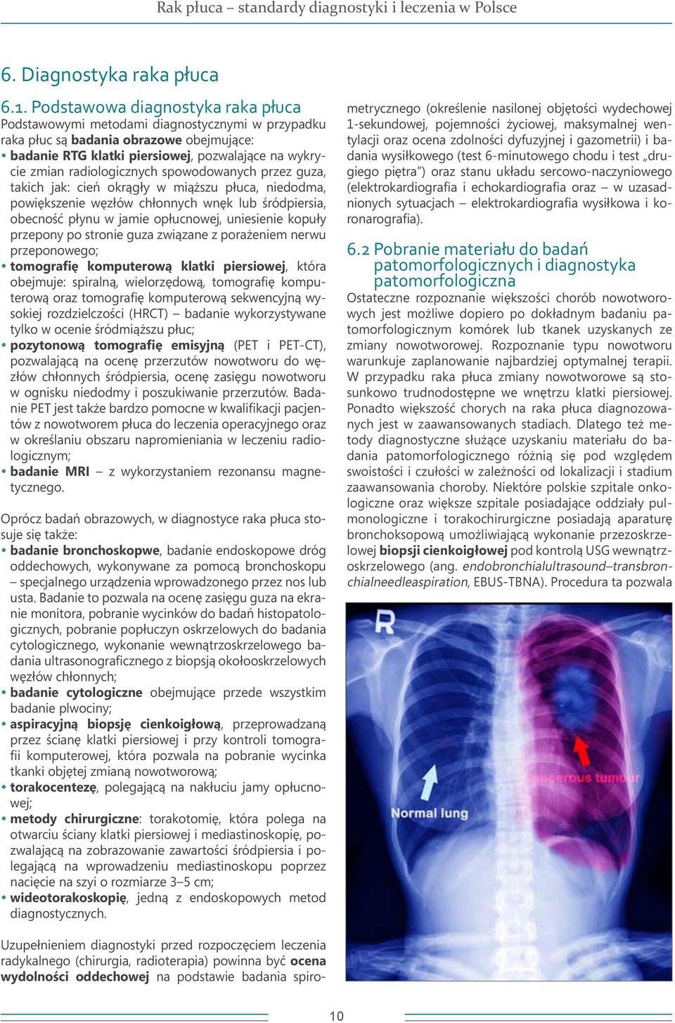 radiologicznych spowodowanych przez guza, takich jak: cień okrągły w miąższu płuca, niedodma, powiększenie węzłów chłonnych wnęk lub śródpiersia, obecność płynu w jamie opłucnowej, uniesienie kopuły