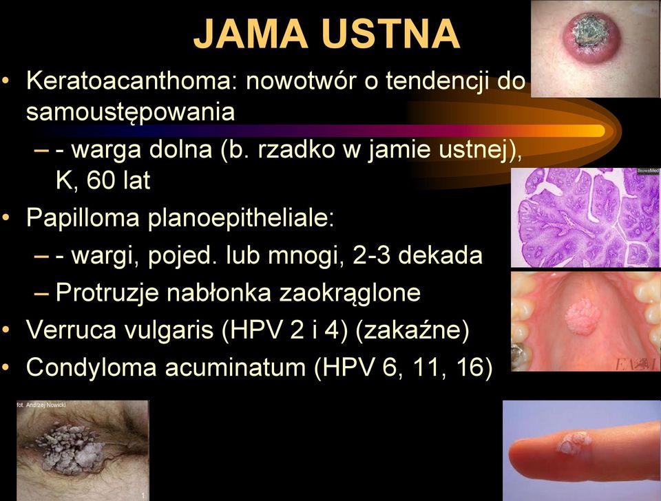 rzadko w jamie ustnej), K, 60 lat Papilloma planoepitheliale: - wargi,