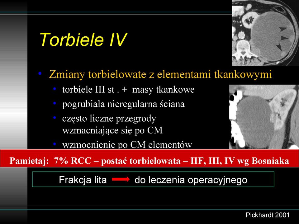 się po CM wzmocnienie po CM elementów tkankowych (guzki, nieregularne masy) Pamietaj: