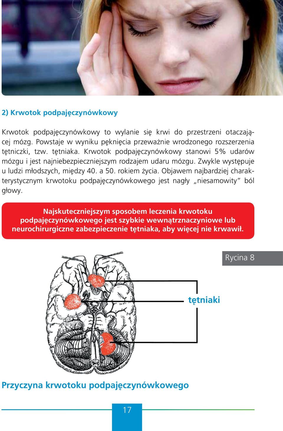 Krwotok podpajęczynówkowy stanowi 5% udarów mózgu i jest najniebezpieczniejszym rodzajem udaru mózgu. Zwykle występuje u ludzi młodszych, między 40. a 50. rokiem życia.