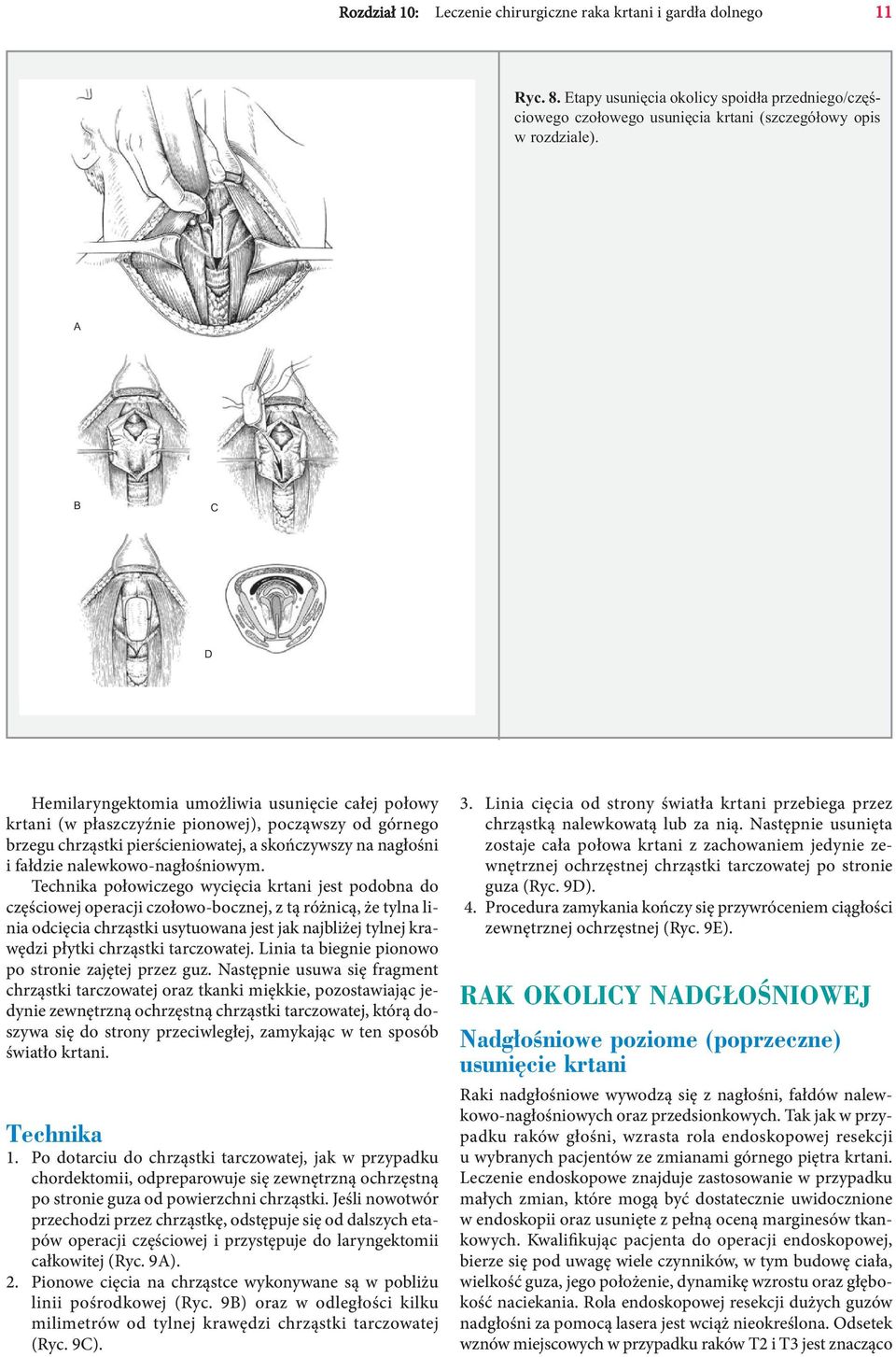 nalewkowo-nagłośniowym.