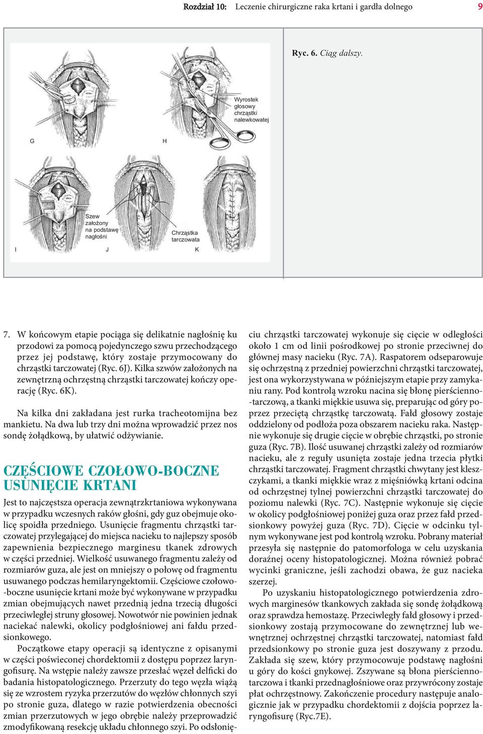Kilka szwów założonych na zewnętrzną ochrzęstną chrząstki tarczowatej kończy operację (Ryc. 6K). Na kilka dni zakładana jest rurka tracheotomijna bez mankietu.