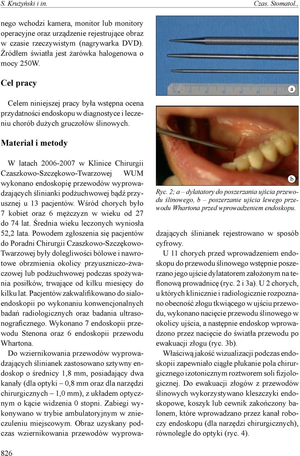 Materiał i metody Ryc. 2; a dylatatory do poszerzania ujścia przewodu ślinowego, b poszerzanie ujścia lewego przewodu Whartona przed wprowadzeniem endoskopu.