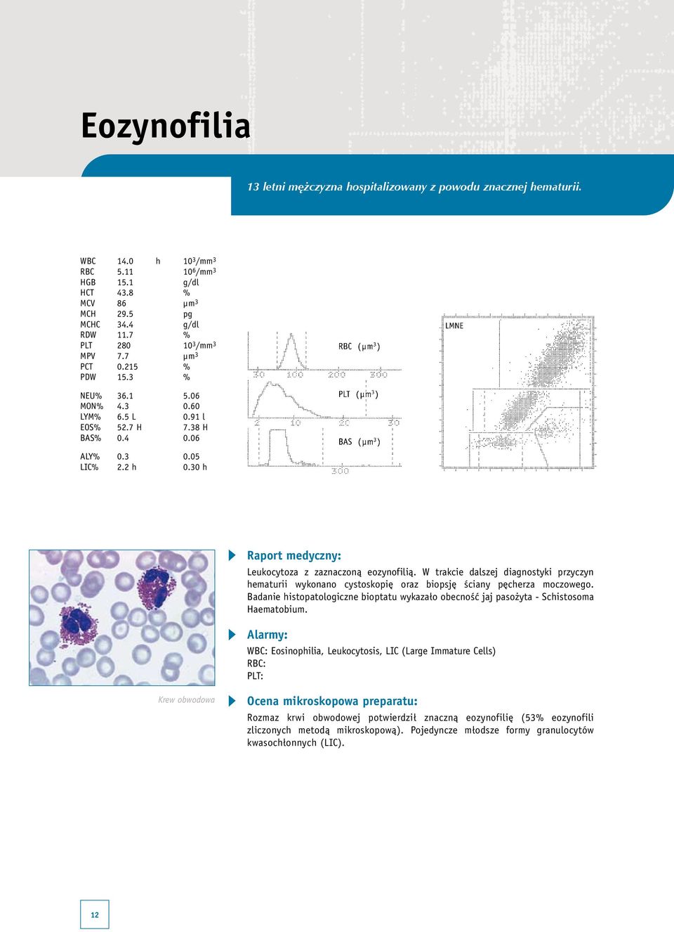 30 h Leukocytoza z zaznaczoną eozynofilią. W trakcie dalszej diagnostyki przyczyn hematurii wykonano cystoskopię oraz biopsję ściany pęcherza moczowego.