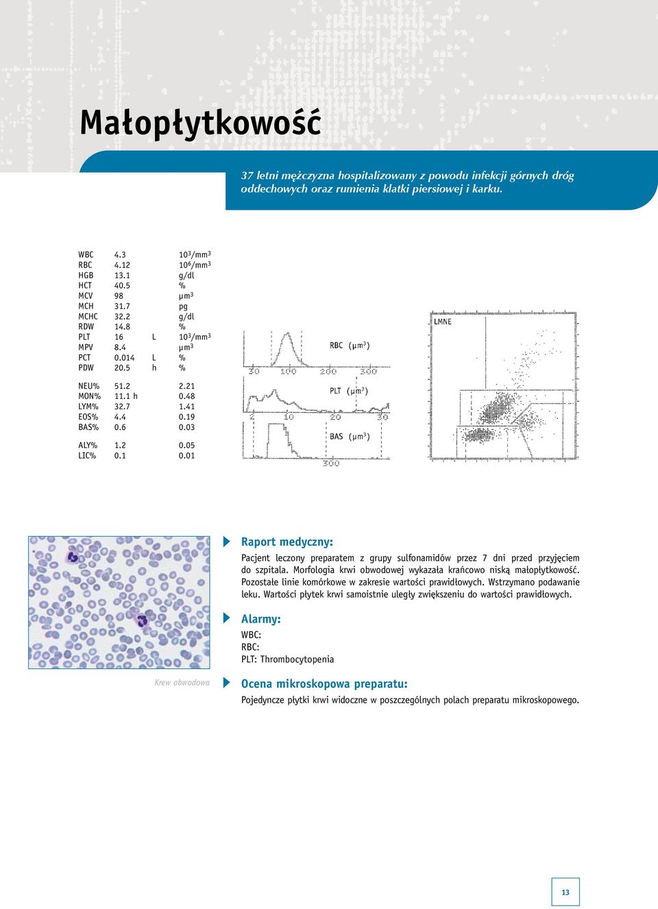 05 LIC% 0.1 0.01 Pacjent leczony preparatem z grupy sulfonamidów przez 7 dni przed przyjęciem do szpitala. Morfologia krwi obwodowej wykazała krańcowo niską małopłytkowość.