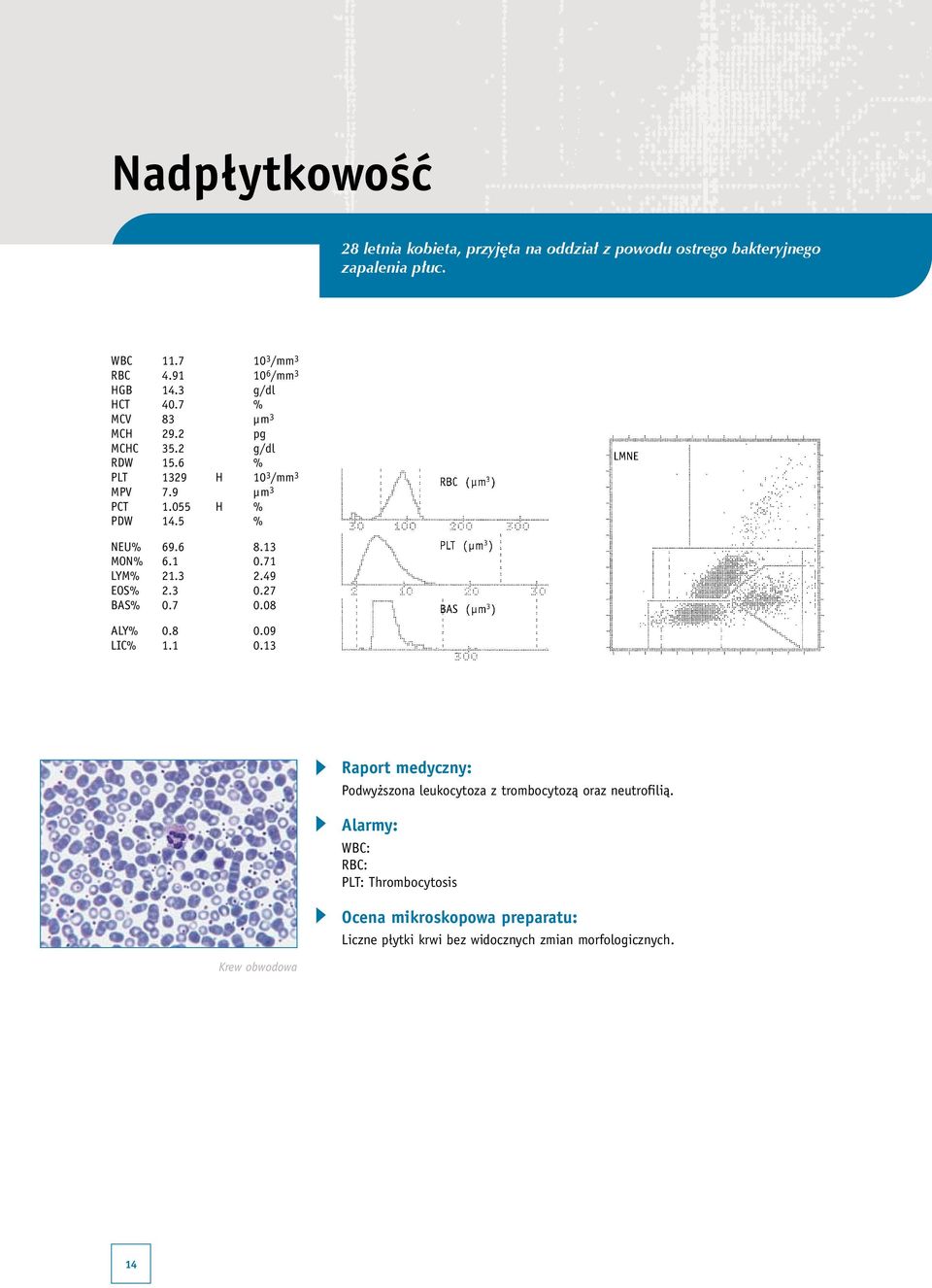 055 H % PDW 14.5 % NEU% 69.6 8.13 MON% 6.1 0.71 LYM% 21.3 2.49 EOS% 2.3 0.27 BAS% 0.7 0.08 ALY% 0.8 0.09 LIC% 1.1 0.13 Podwyższona leukocytoza z trombocytozą oraz neutrofilią.