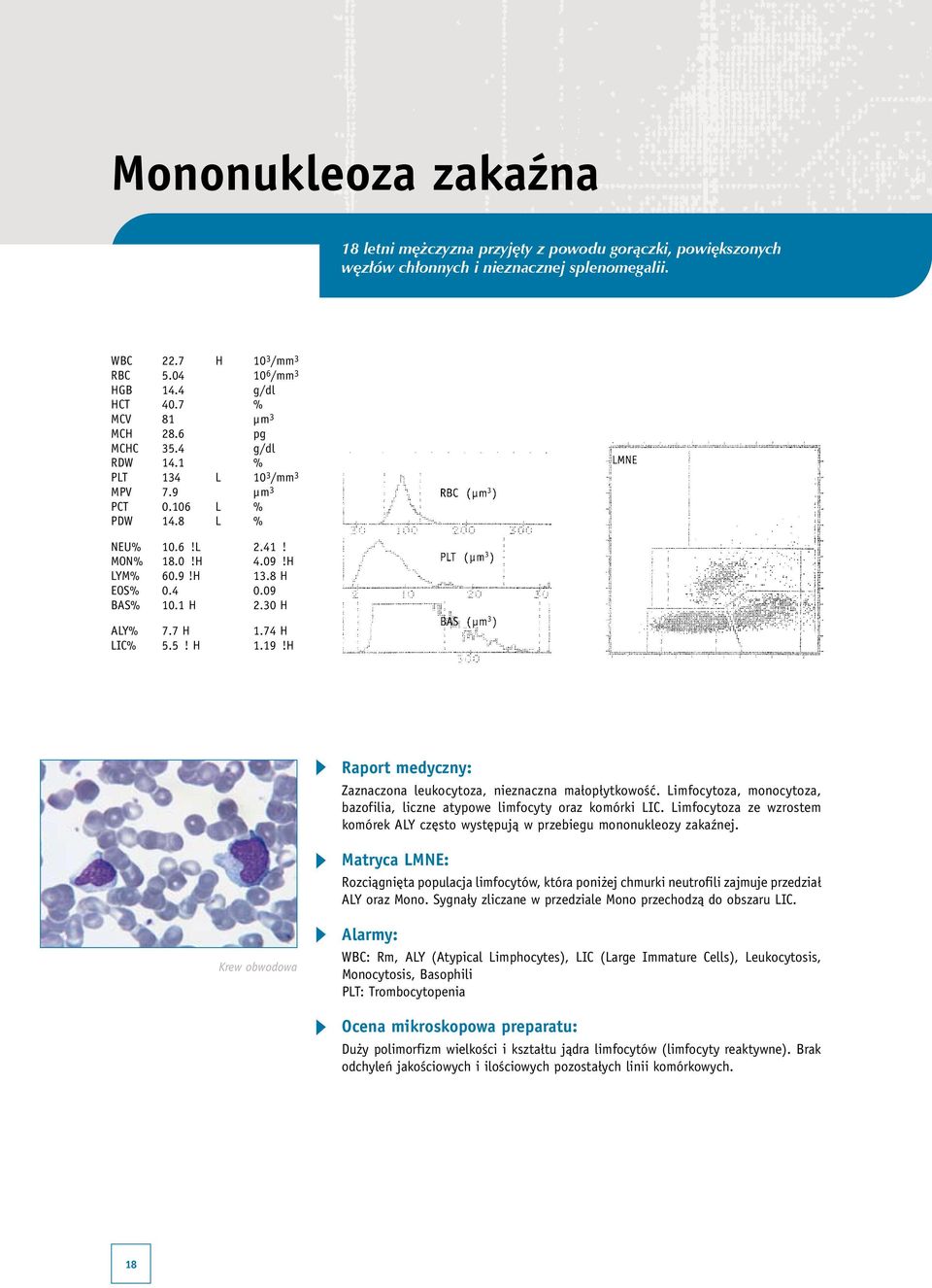 30 H ALY% 7.7 H 1.74 H LIC% 5.5! H 1.19!H Zaznaczona leukocytoza, nieznaczna małopłytkowość. Limfocytoza, monocytoza, bazofilia, liczne atypowe limfocyty oraz komórki LIC.