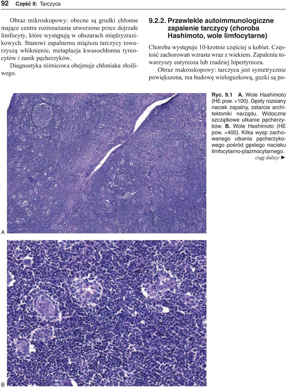 2. Przewlekle autoimmunologiczne zapalenie tarczycy (choroba Hashimoto, wole limfocytarne) Choroba występuje 10-krotnie częściej u kobiet. Częstość zachorowań wzrasta wraz z wiekiem.