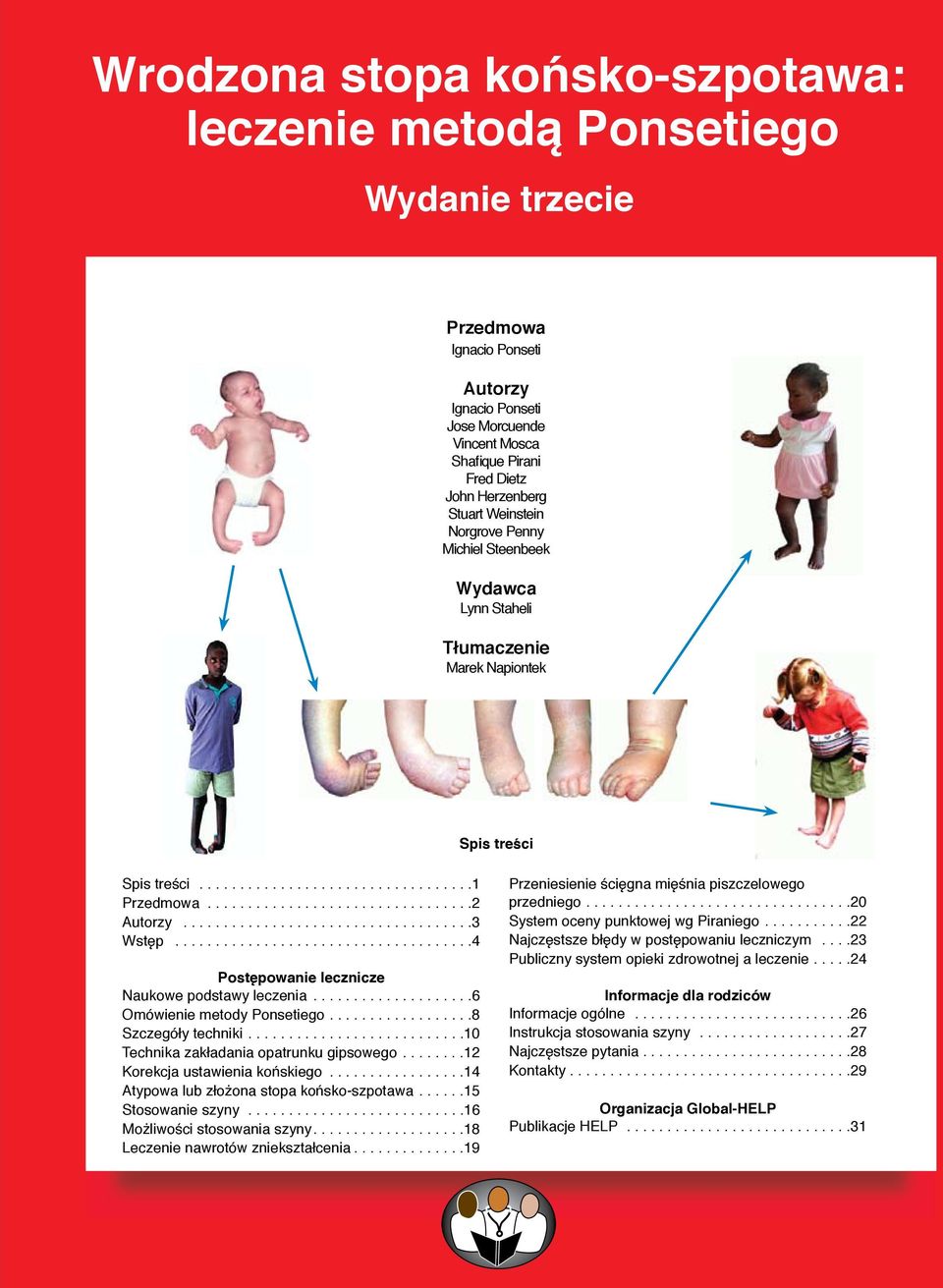 leczenia 6 Omówienie metody Ponsetiego 8 Szczegóły techniki 0 Technika zakładania opatrunku gipsowego 2 Korekcja ustawienia końskiego 4 Atypowa lub złożona stopa końsko-szpotawa 5 Stosowanie szyny 6