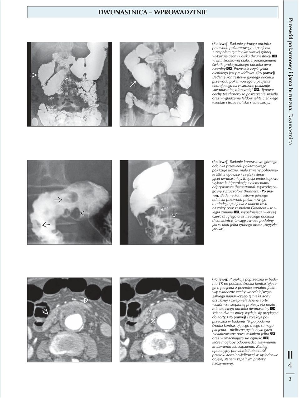 (Po prawej) Badanie kontrastowe górnego odcinka przewodu pokarmowego u pacjenta chorującego na twardzinę pokazuje dwunastnicę olbrzymią.
