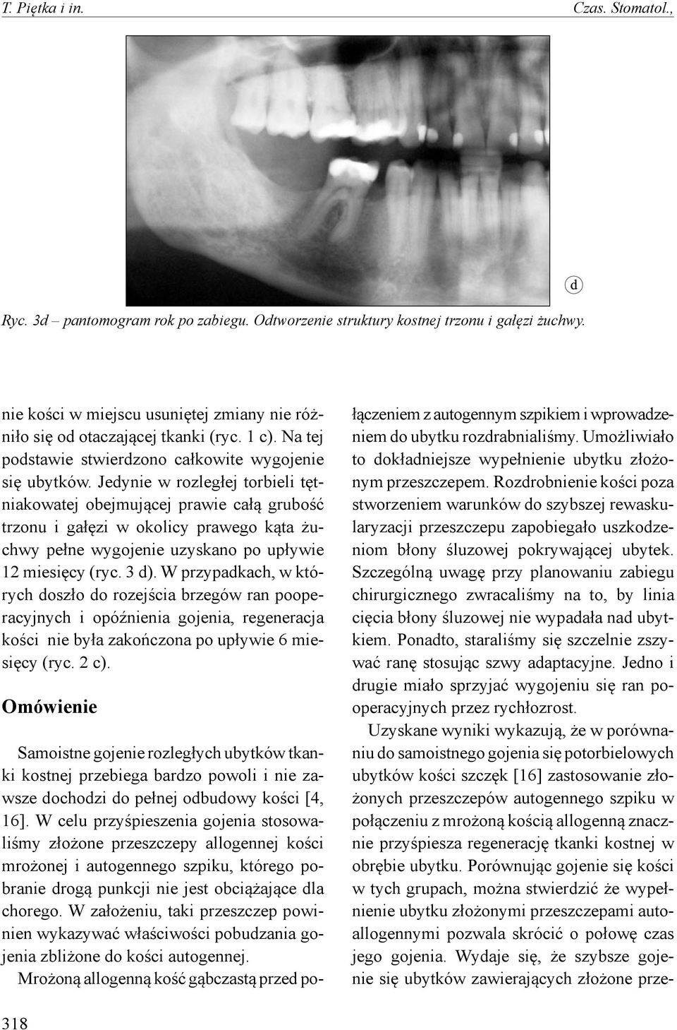 Jedynie w rozległej torbieli tętniakowatej obejmującej prawie całą grubość trzonu i gałęzi w okolicy prawego kąta żuchwy pełne wygojenie uzyskano po upływie 12 miesięcy (ryc. 3 d).