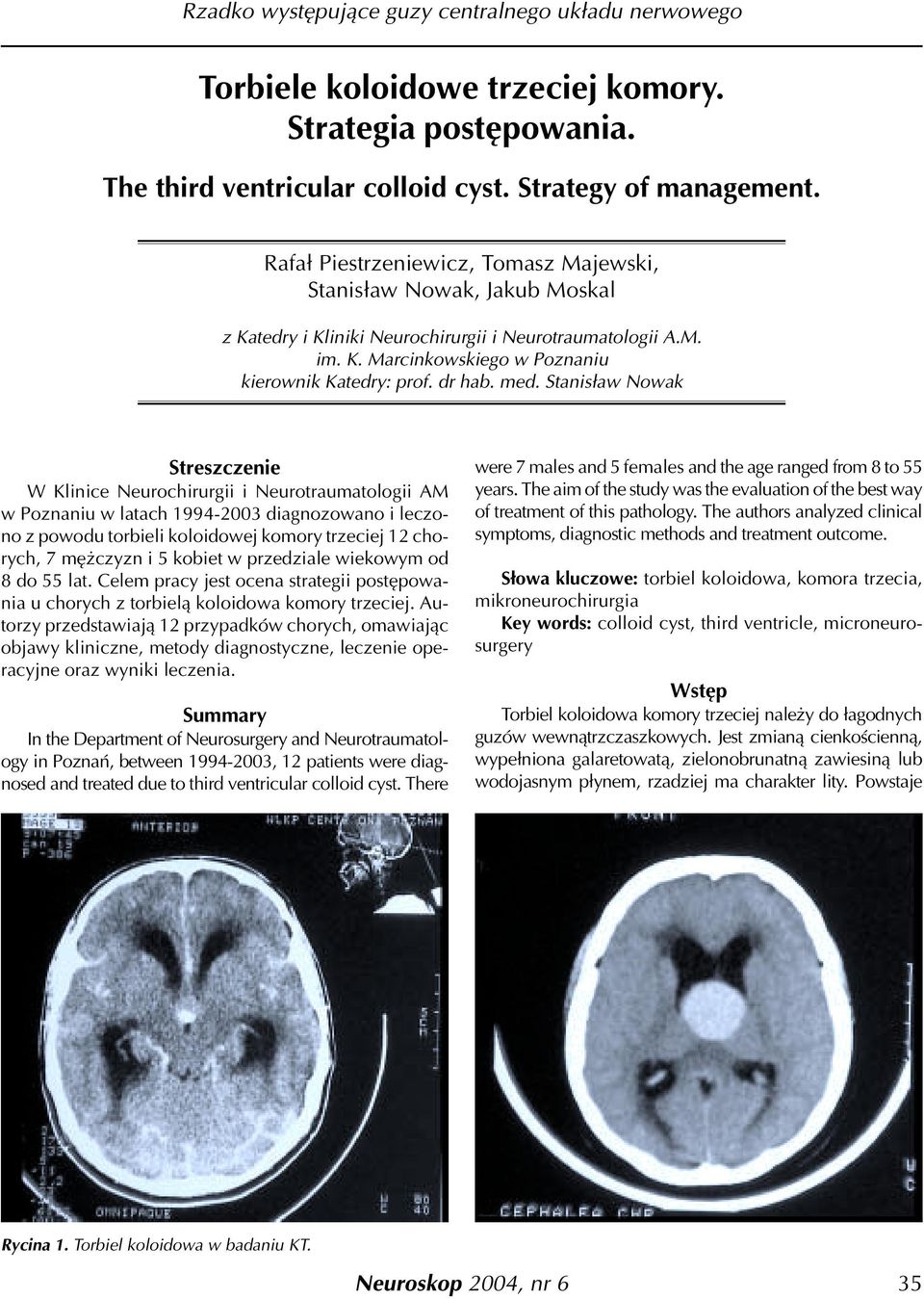 med. Stanis³aw Nowak Streszczenie W Klinice Neurochirurgii i Neurotraumatologii AM w Poznaniu w latach 1994-2003 diagnozowano i leczono z powodu torbieli koloidowej komory trzeciej 12 chorych, 7 mê