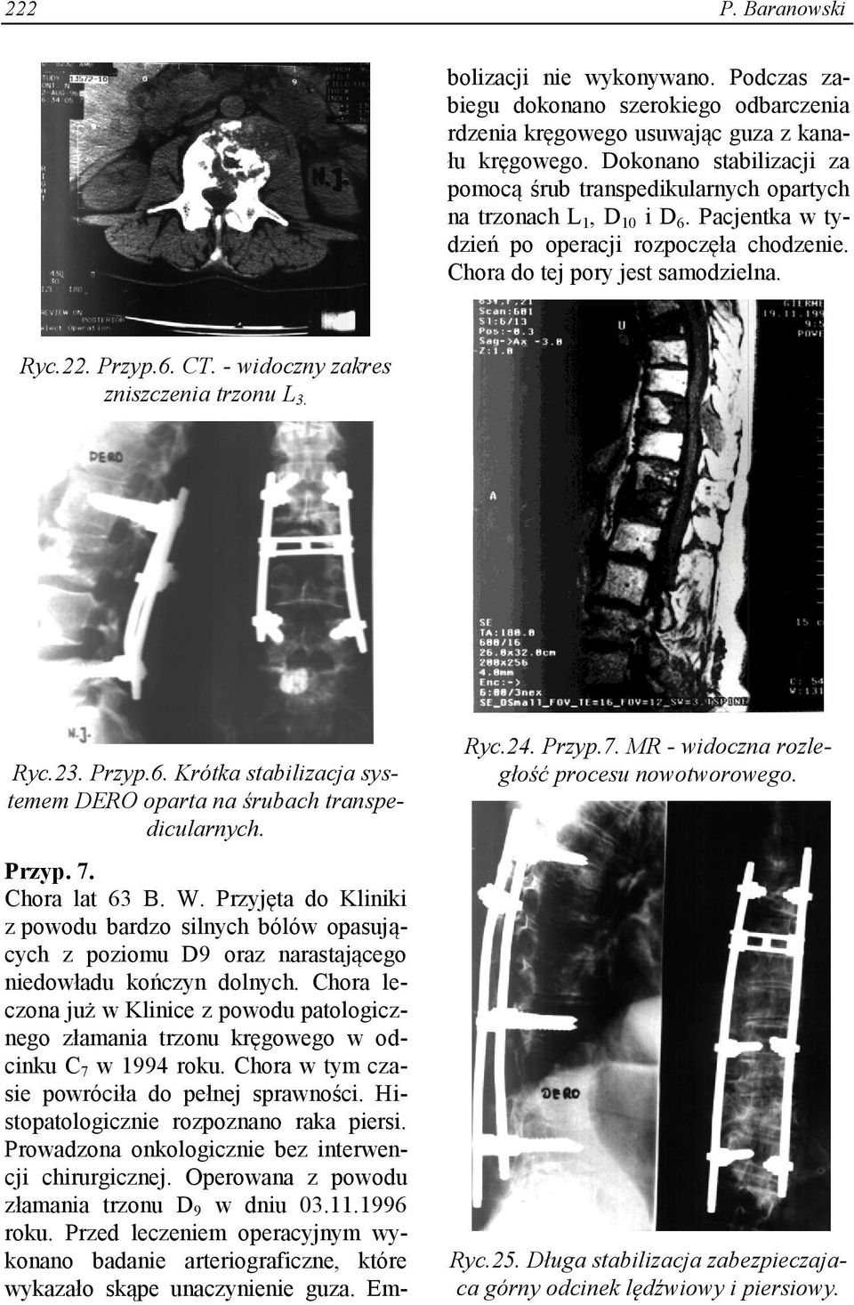 Prowadzona onkologicznie bez interwencji chirurgicznej. Operowana z powodu złamania trzonu D 9 w dniu 03.11.1996 roku.