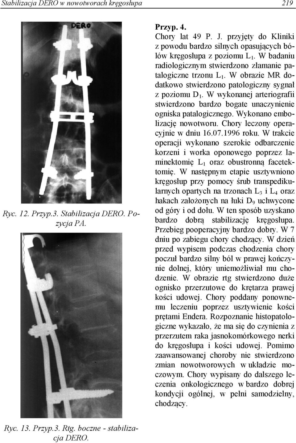 W obrazie MR dodatkowo stwierdzono patologiczny sygnał z poziomu D 1. W wykonanej arteriografii stwierdzono bardzo bogate unaczynienie ogniska patalogicznego. Wykonano embolizację nowotworu.