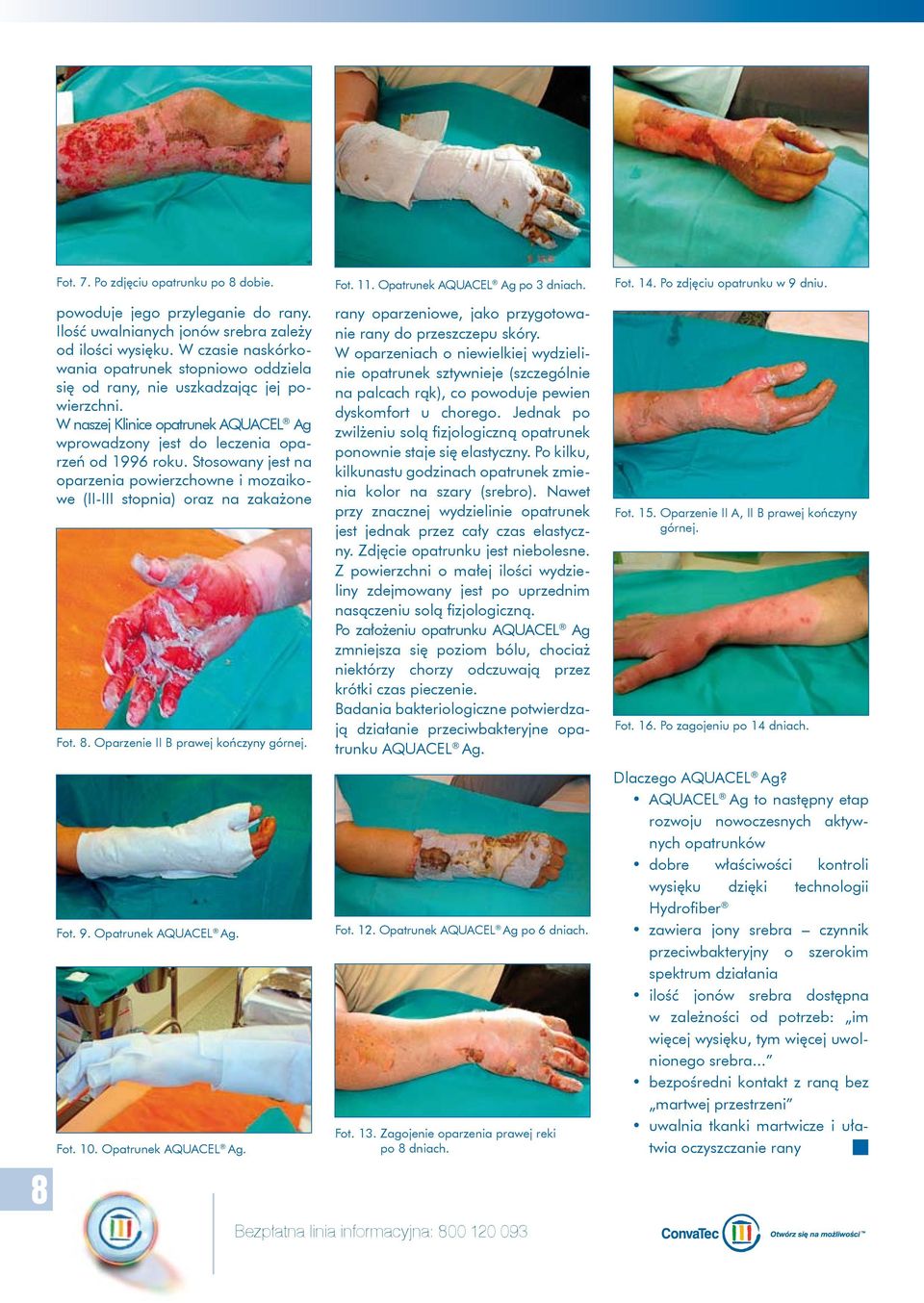 Stosowany jest na oparzenia powierzchowne i mozaikowe (II-III stopnia) oraz na zakażone Fot. 8. Oparzenie II B prawej kończyny górnej. Fot. 9. Opatrunek AQUACEL Ag. Fot. 10. Opatrunek AQUACEL Ag. Fot. 11.