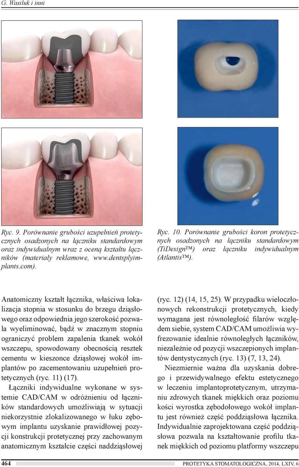 Anatomiczny kształt łącznika, właściwa lokalizacja stopnia w stosunku do brzegu dziąsłowego oraz odpowiednia jego szerokość pozwala wyeliminować, bądź w znacznym stopniu ograniczyć problem zapalenia