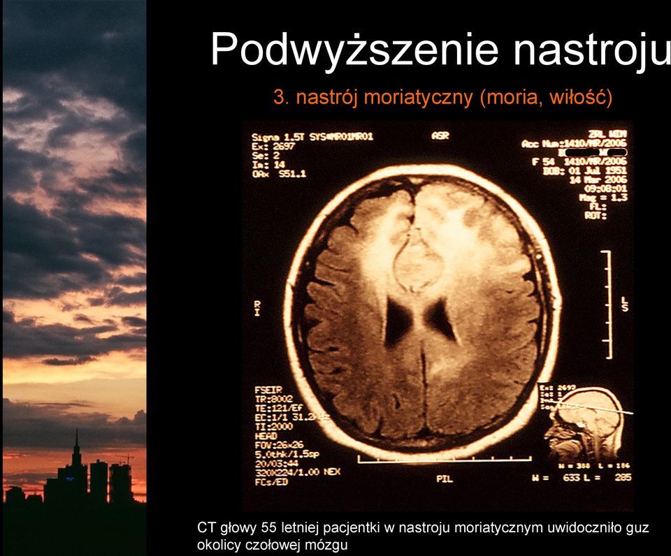 głowy 55 letniej pacjentki w nastroju