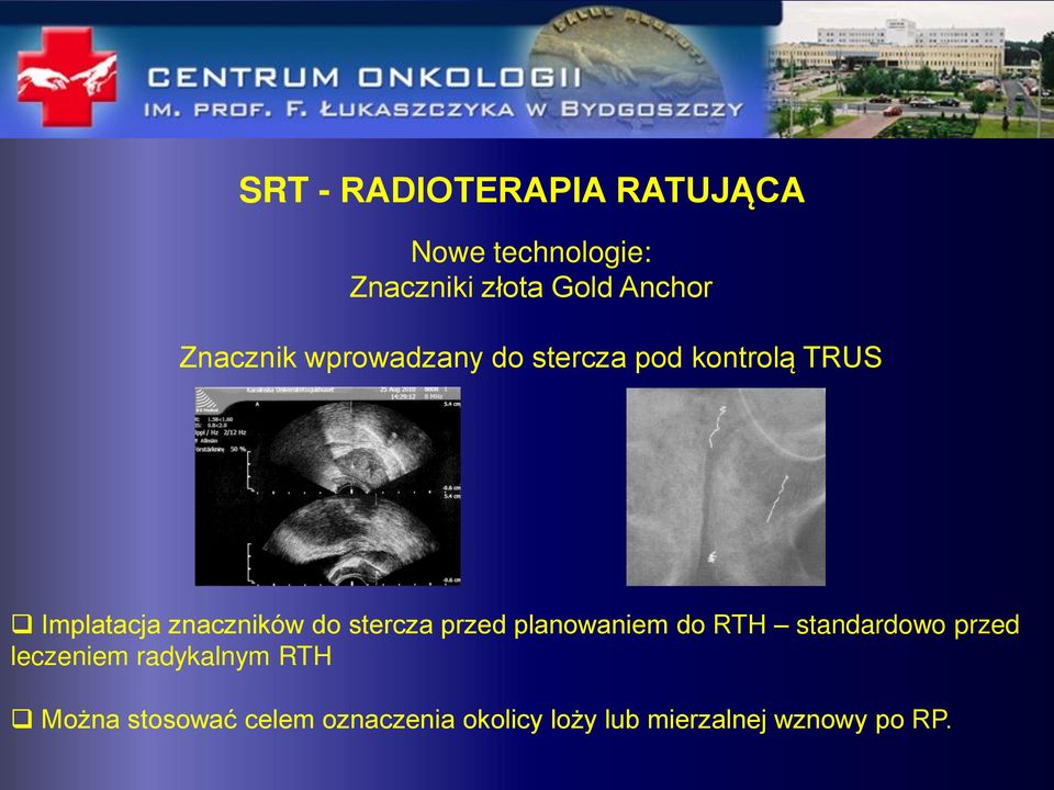 stercza przed planowaniem do RTH standardowo przed leczeniem radykalnym