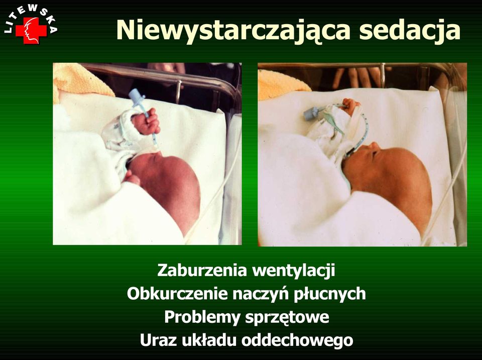 Obkurczenie naczyń płucnych