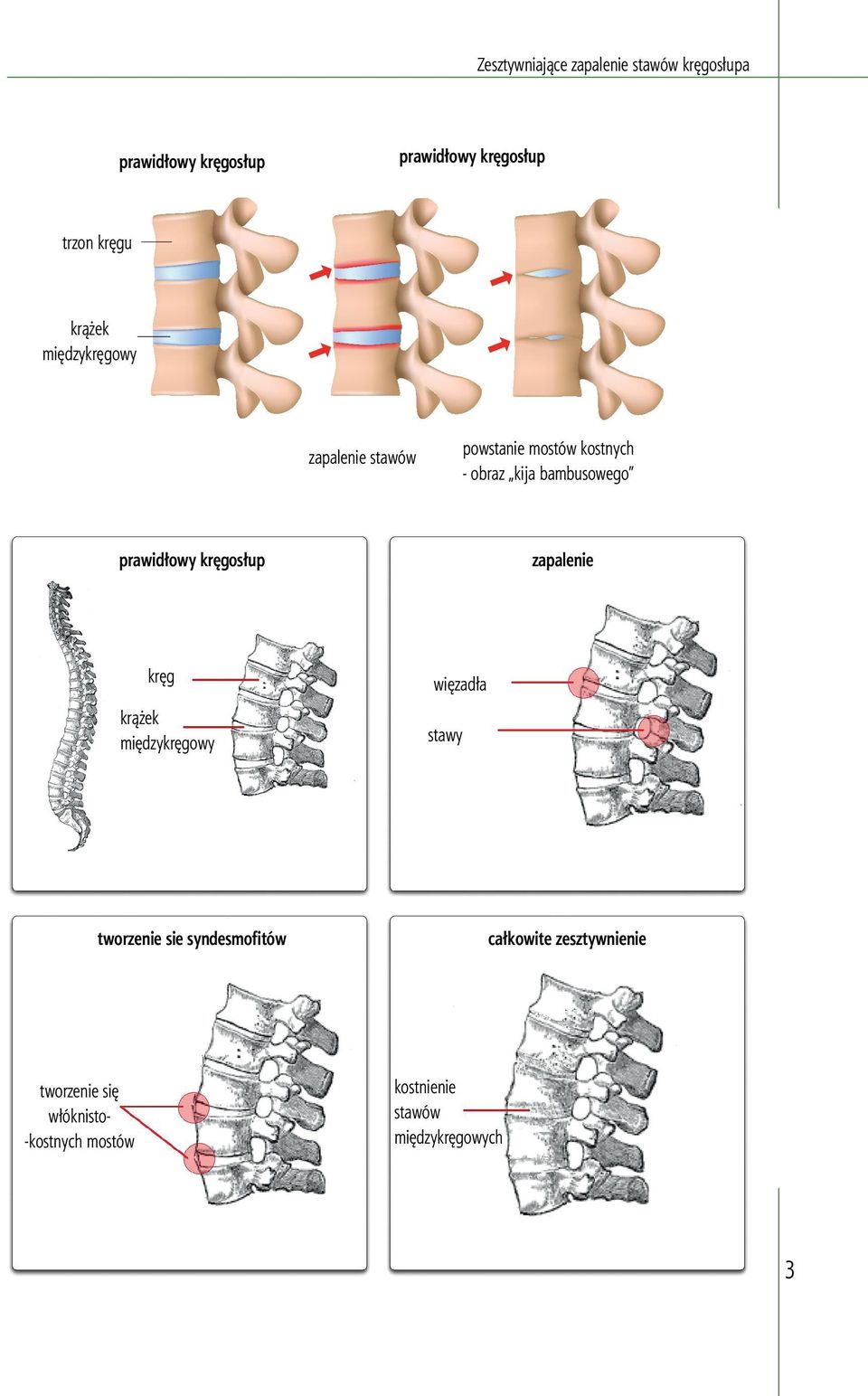 prawidłowy kręgosłup kręg krążek międzykręgowy tworzenie sie syndesmofitów tworzenie się