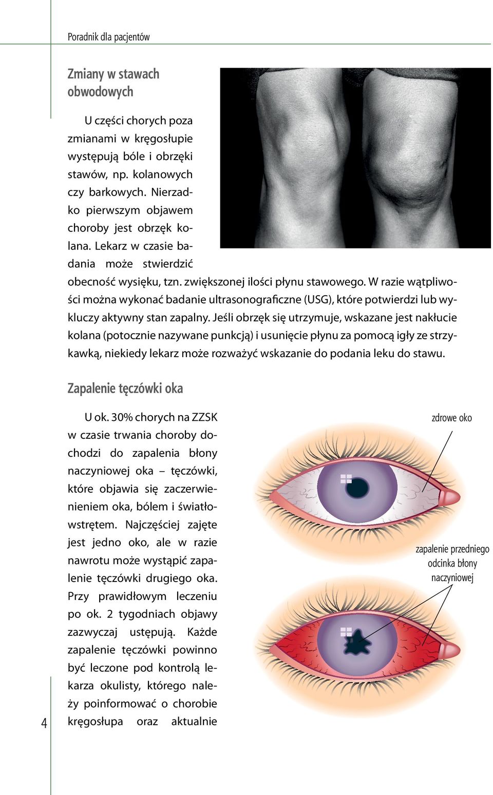 W razie wątpliwości można wykonać badanie ultrasonograficzne (USG), które potwierdzi lub wykluczy aktywny stan zapalny.