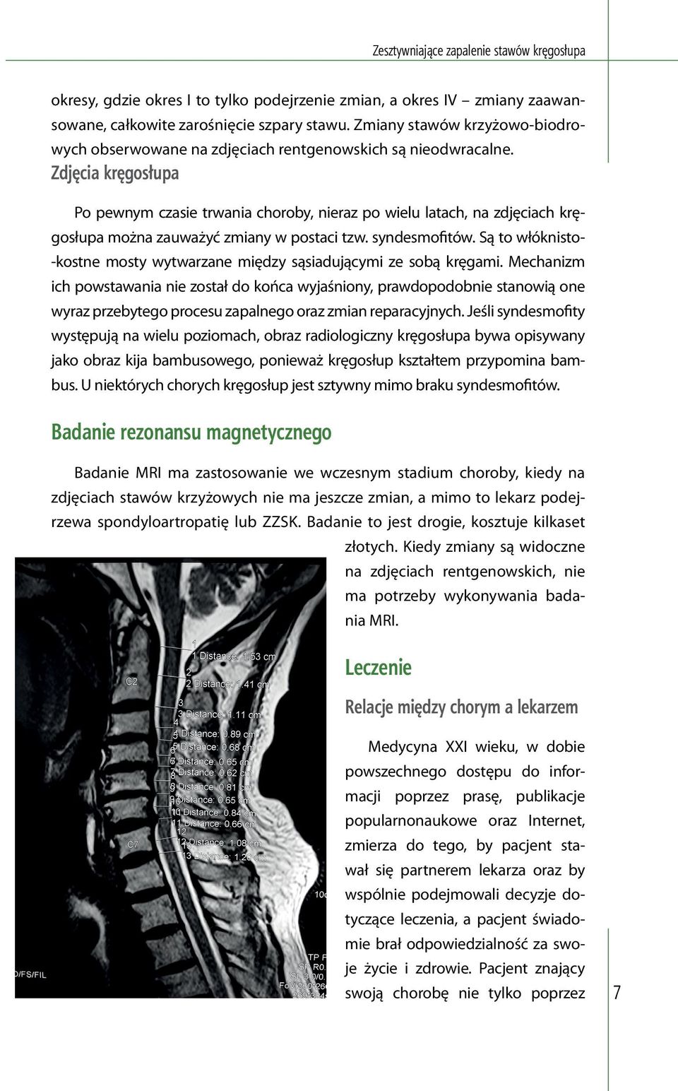 Zdjęcia kręgosłupa Po pewnym czasie trwania choroby, nieraz po wielu latach, na zdjęciach kręgosłupa można zauważyć zmiany w postaci tzw. syndesmofitów.