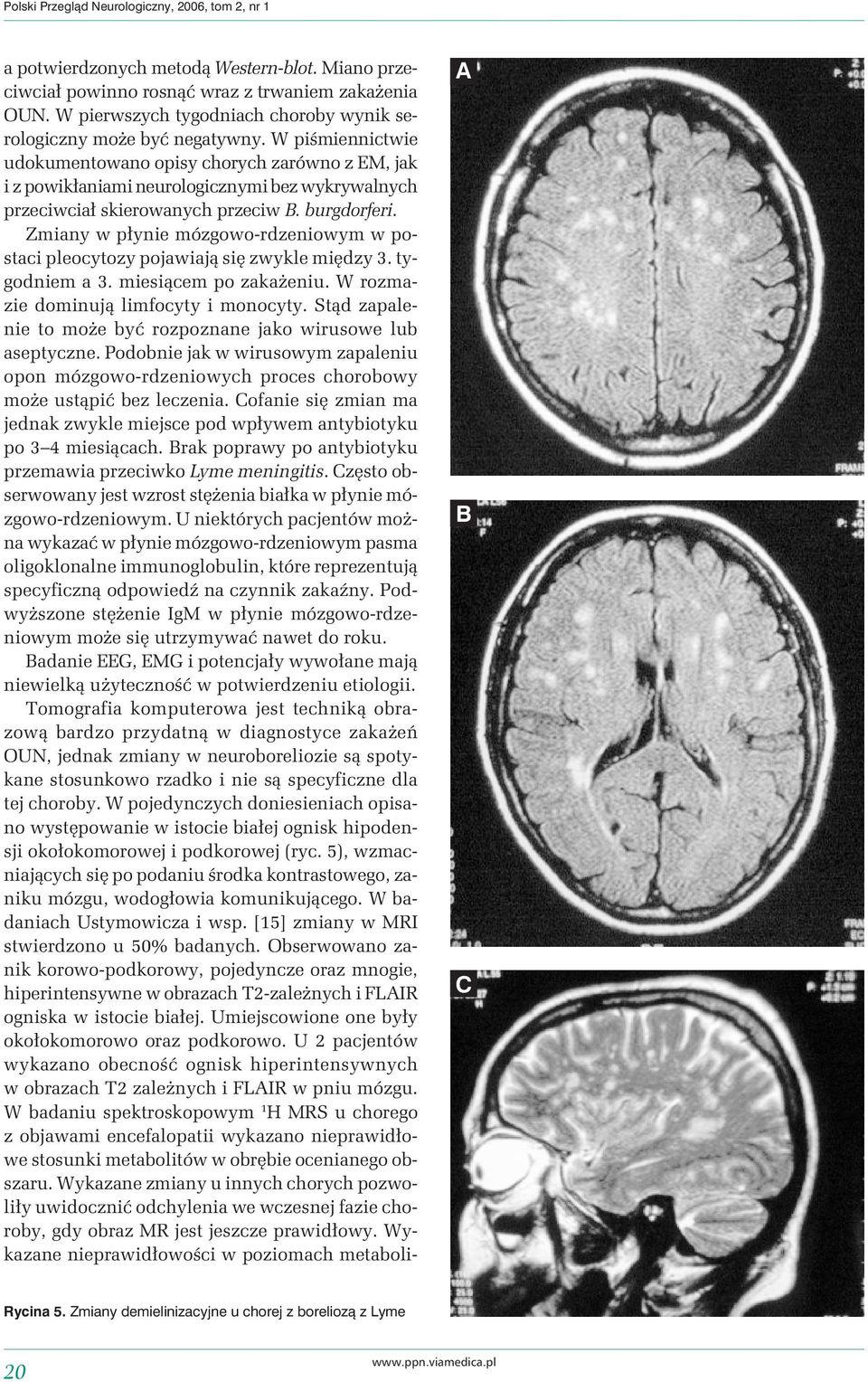 W piśmiennictwie udokumentowano opisy chorych zarówno z EM, jak i z powikłaniami neurologicznymi bez wykrywalnych przeciwciał skierowanych przeciw B. burgdorferi.