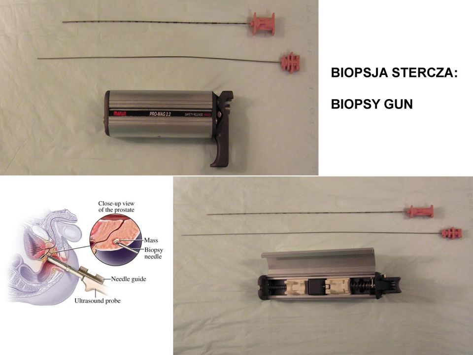 BIOPSY