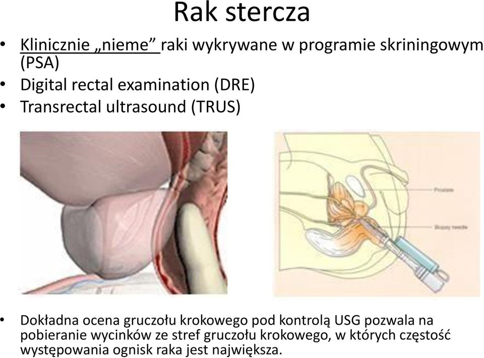 gruczołu krokowego pod kontrolą USG pozwala na pobieranie wycinków ze stref