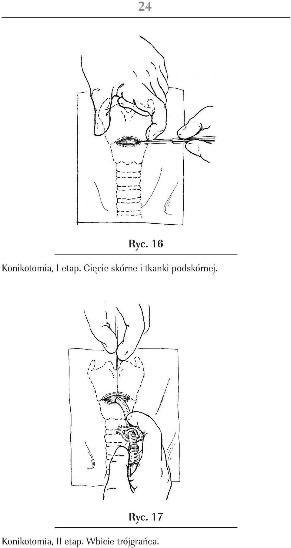 Cięcie skórne i tkanki