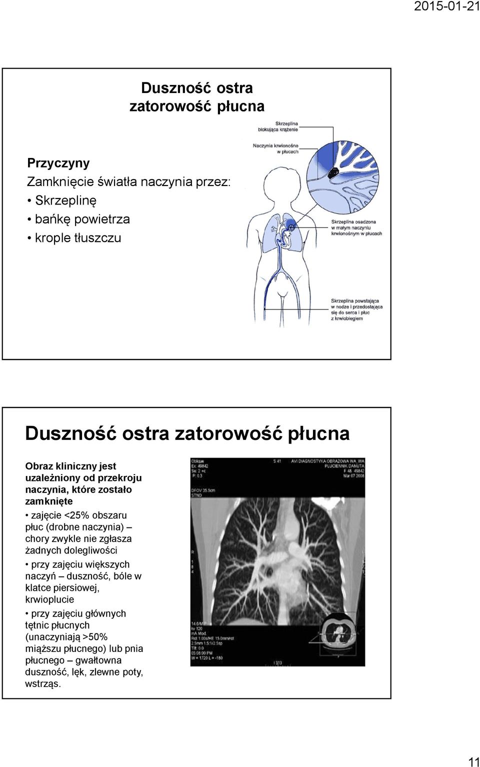 naczynia) chory zwykle nie zgłasza żadnych dolegliwości przy zajęciu większych naczyń duszność, bóle w klatce piersiowej, krwioplucie