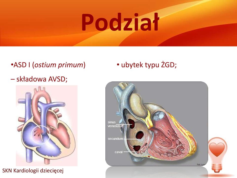 składowa AVSD;