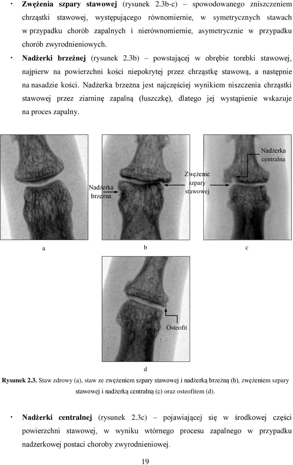 zwyrodnieniowych. Nadżerki brzeżnej (rysunek 2.3b) powstającej w obrębie torebki stawowej, najpierw na powierzchni kości niepokrytej przez chrząstkę stawową, a następnie na nasadzie kości.