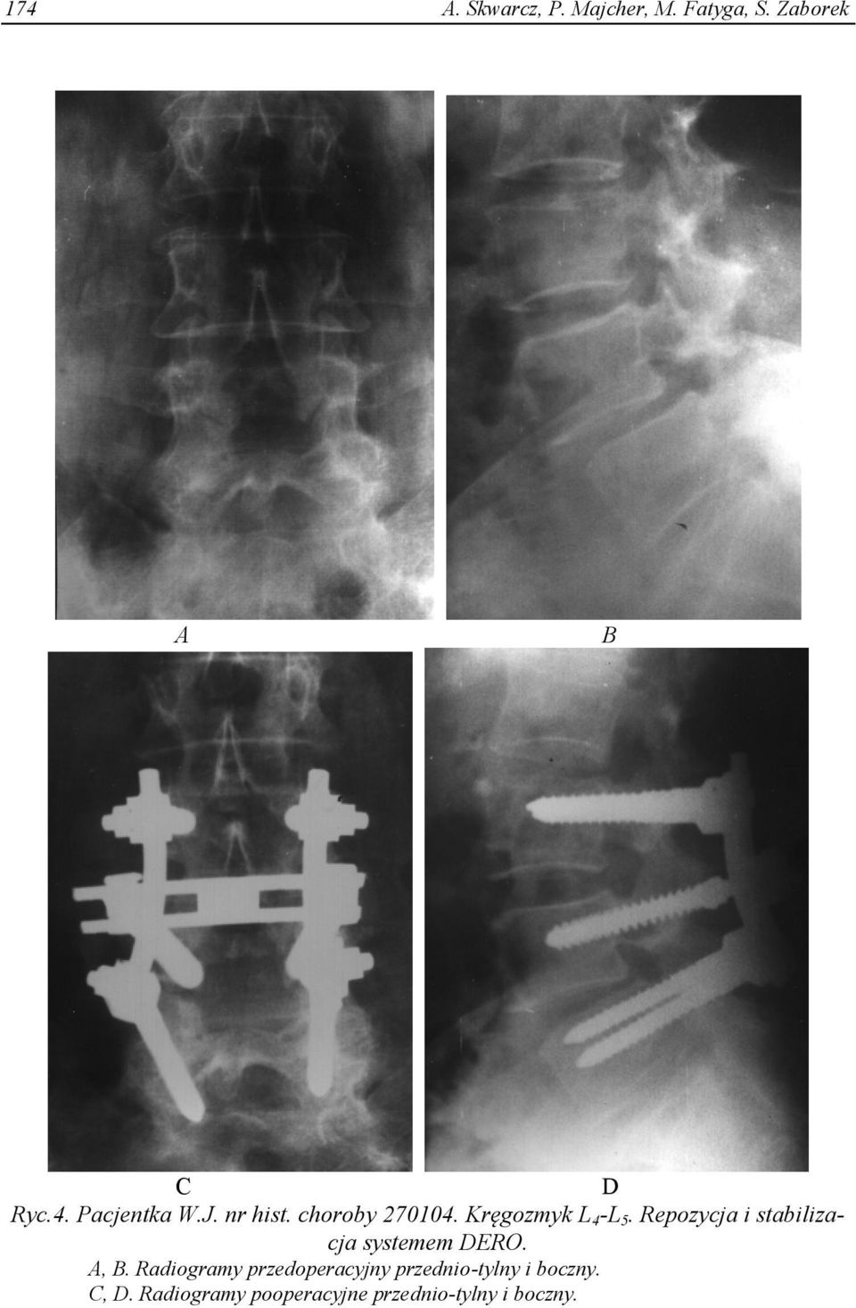 Repozycja i stabilizacja systemem DERO. A, B.