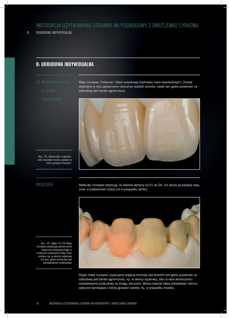 Wspaniałe, indywidualne rezultaty można uzyskać w kilku prostych krokach. INCREASER Materiały Increaser obejmują 16 kolorów dentyny od A1 do D4.
