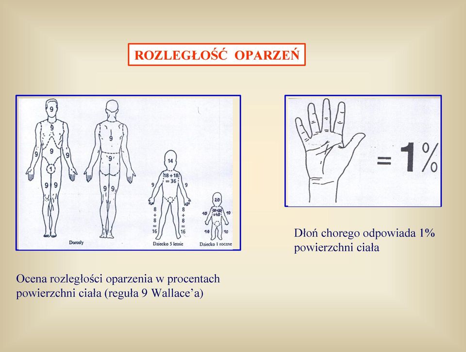 powierzchni ciała (reguła 9 Wallace