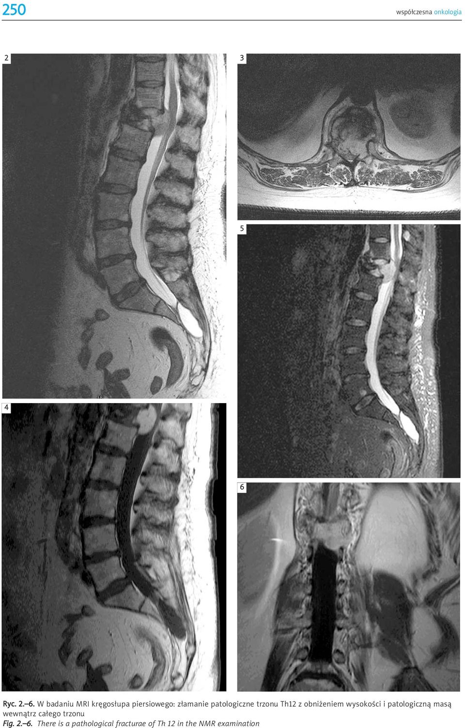 W badaniu MRI kręgosłupa piersiowego: złamanie patologiczne