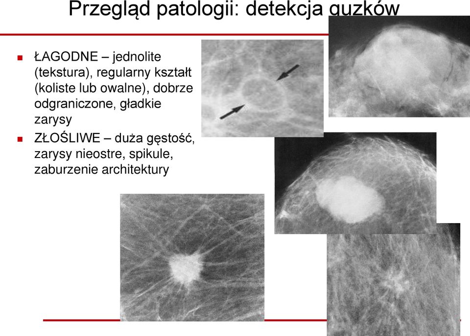 dobrze odgraniczone, gładkie zarysy ZŁOŚLIWE duża