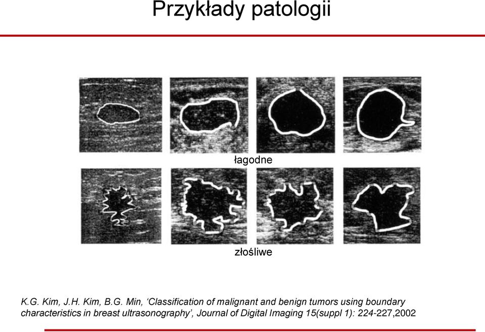 Min, Classification of malignant and benign tumors