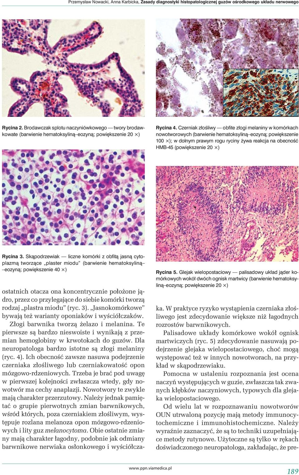 Czerniak złośliwy obfite złogi melaniny w komórkach nowotworowych (barwienie hematoksyliną eozyną; powiększenie 100 ); w dolnym prawym rogu ryciny żywa reakcja na obecność HMB-45 (powiększenie 20 )