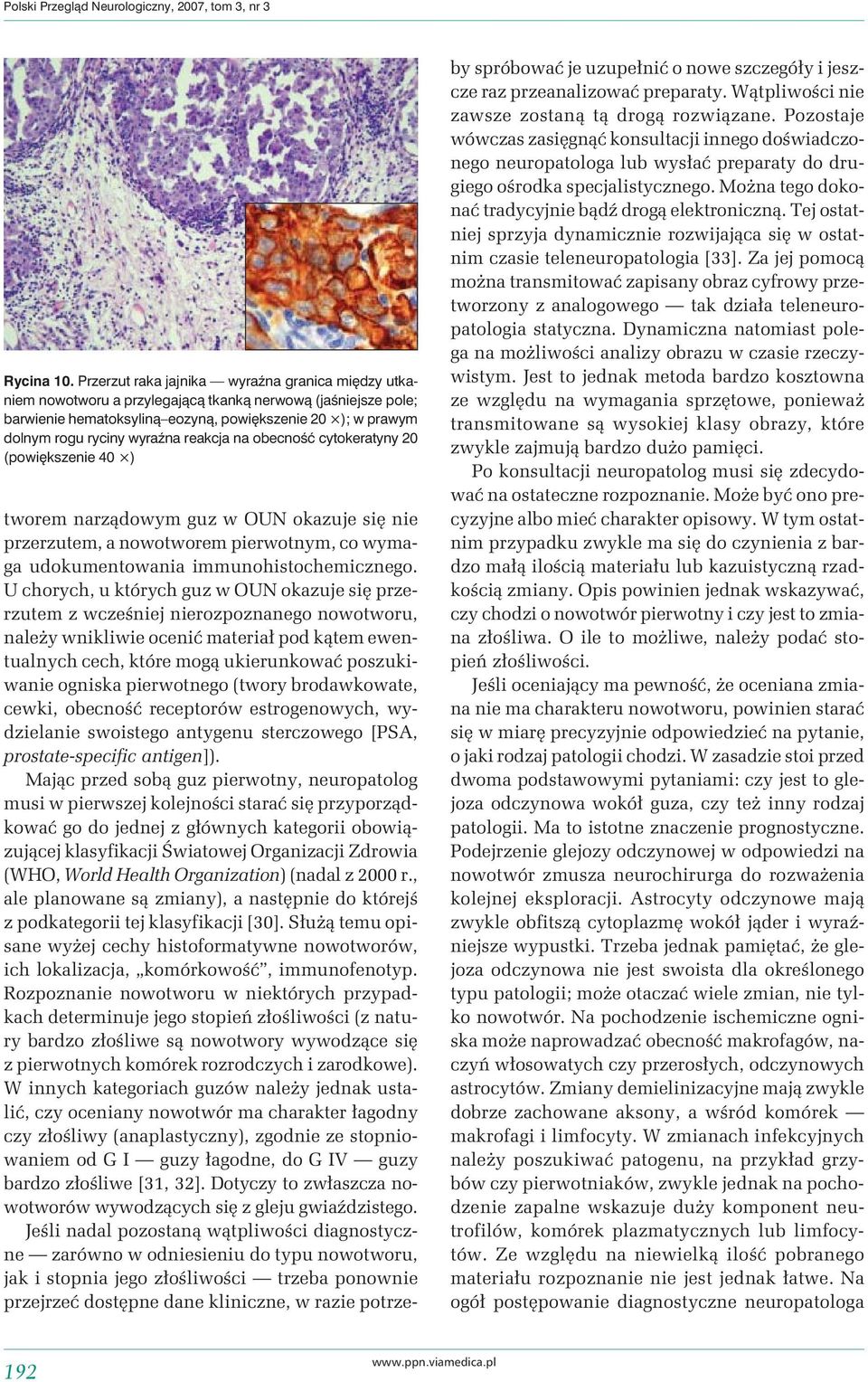 reakcja na obecność cytokeratyny 20 (powiększenie 40 ) tworem narządowym guz w OUN okazuje się nie przerzutem, a nowotworem pierwotnym, co wymaga udokumentowania immunohistochemicznego.