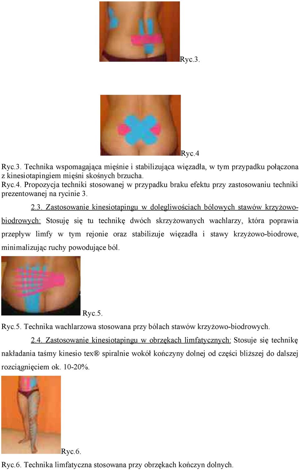 stabilizuje więzadła i stawy krzyżowo-biodrowe, minimalizując ruchy powodujące ból. Ryc.5. Ryc.5. Technika wachlarzowa stosowana przy bólach stawów krzyżowo-biodrowych. 2.4.