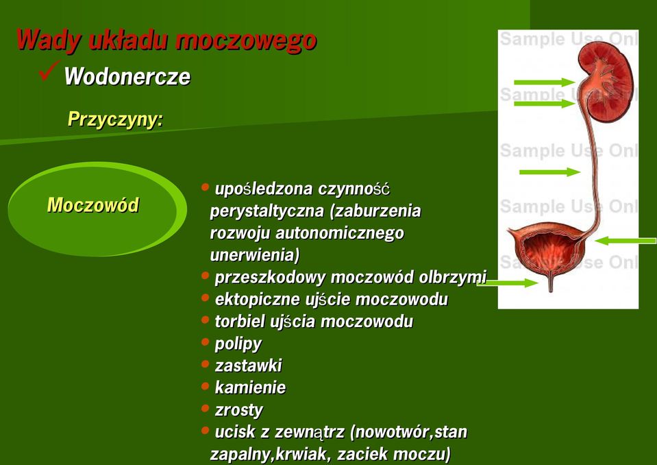 moczowód olbrzymi ektopiczne ujście moczowodu torbiel ujścia moczowodu polipy