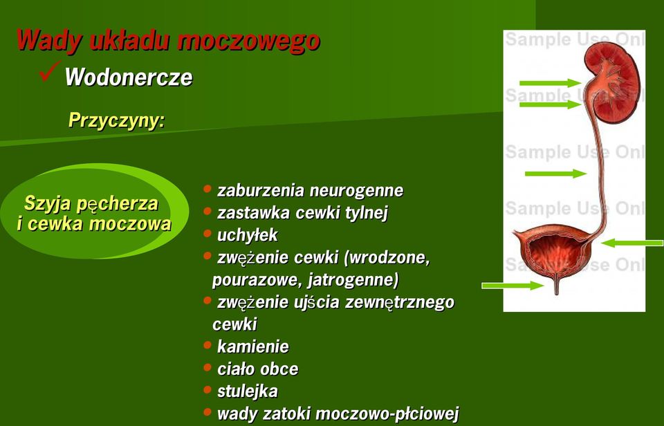 zwężenie cewki (wrodzone, pourazowe, jatrogenne) zwężenie ujścia